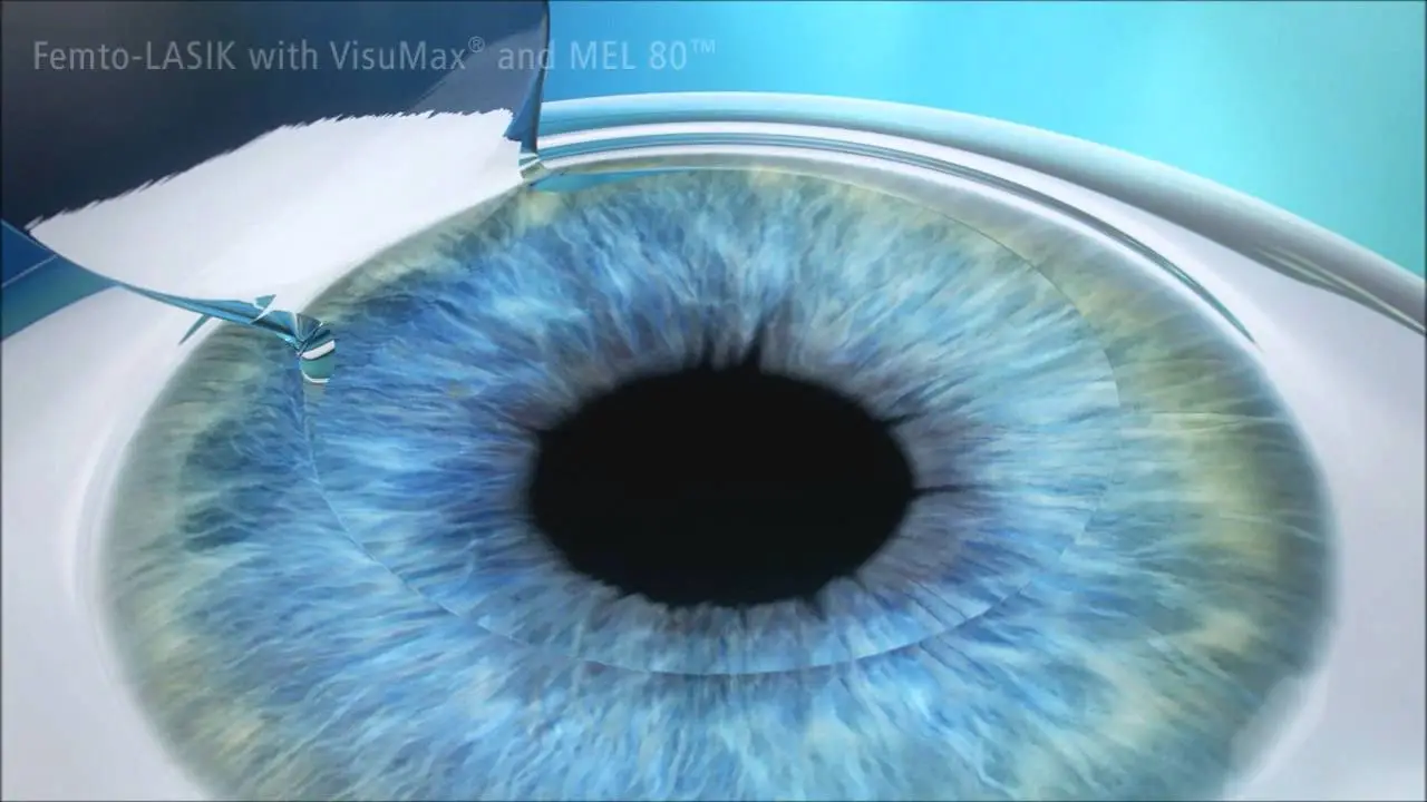 Lasik